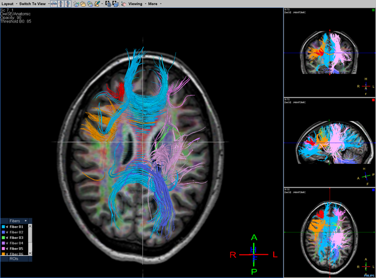 La Resonancia Magnética Cerebral Como Herramienta De Investigación